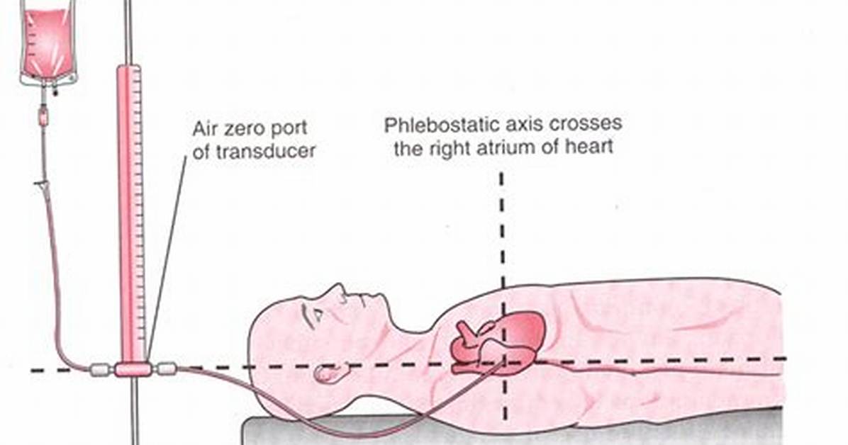 Phlebostatic Axis