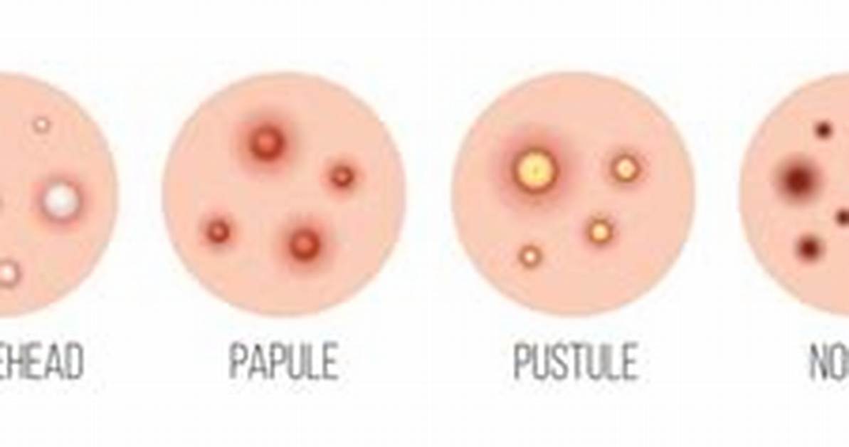 Pimple