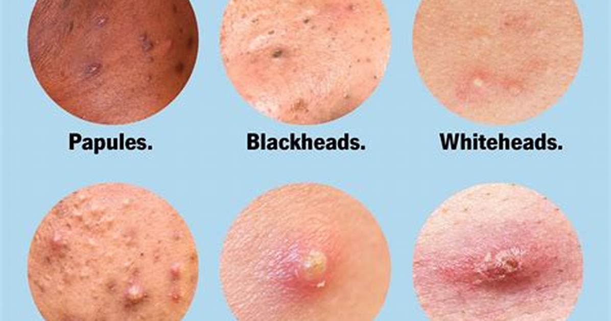 Pimples