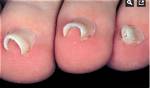 Pincer Nails