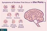 Pons Stroke