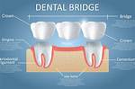 Pontic Dental
