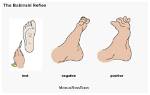 Positive Babinski Test