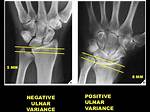 Positive Ulnar Variance