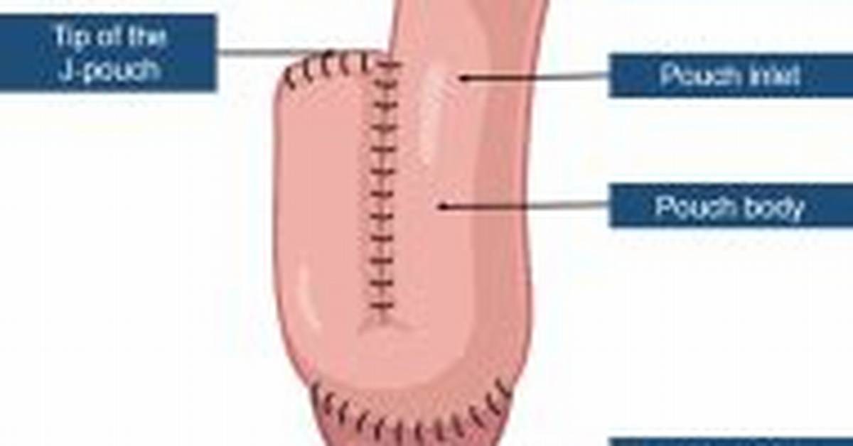 Pouchoscopy