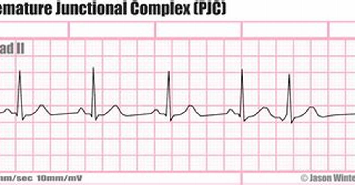 Premature Junctional Complex