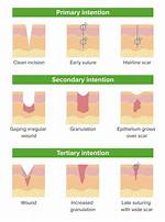Primary Intention Healing
