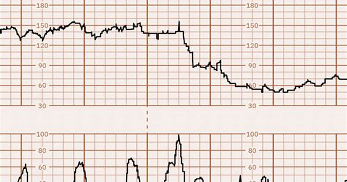 Prolonged Deceleration