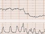 Prolonged Deceleration