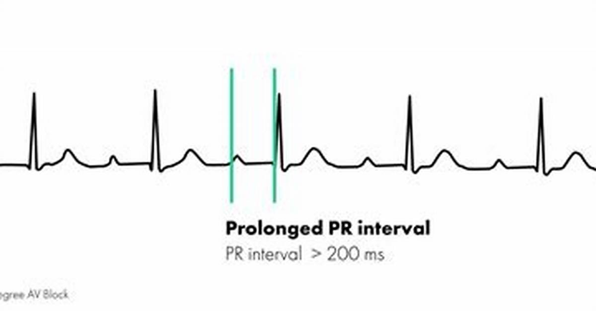 Prolonged Pr Interval