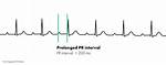 Prolonged Pr Interval