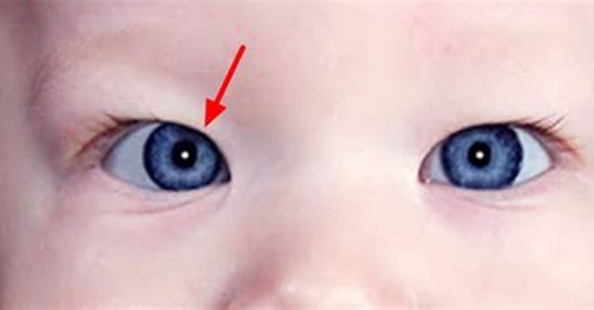 Pseudo Strabismus