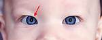 Pseudo Strabismus