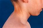 Pseudoxanthoma Elasticum: About This Disease