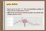 Pulse Deficit Definition