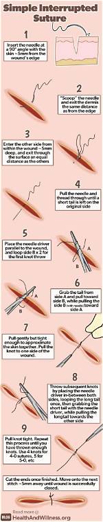 Put in Sutures