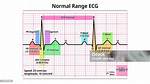 Qrs Normal Range