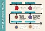 Quick Answer: How to Heal Bruises Faster