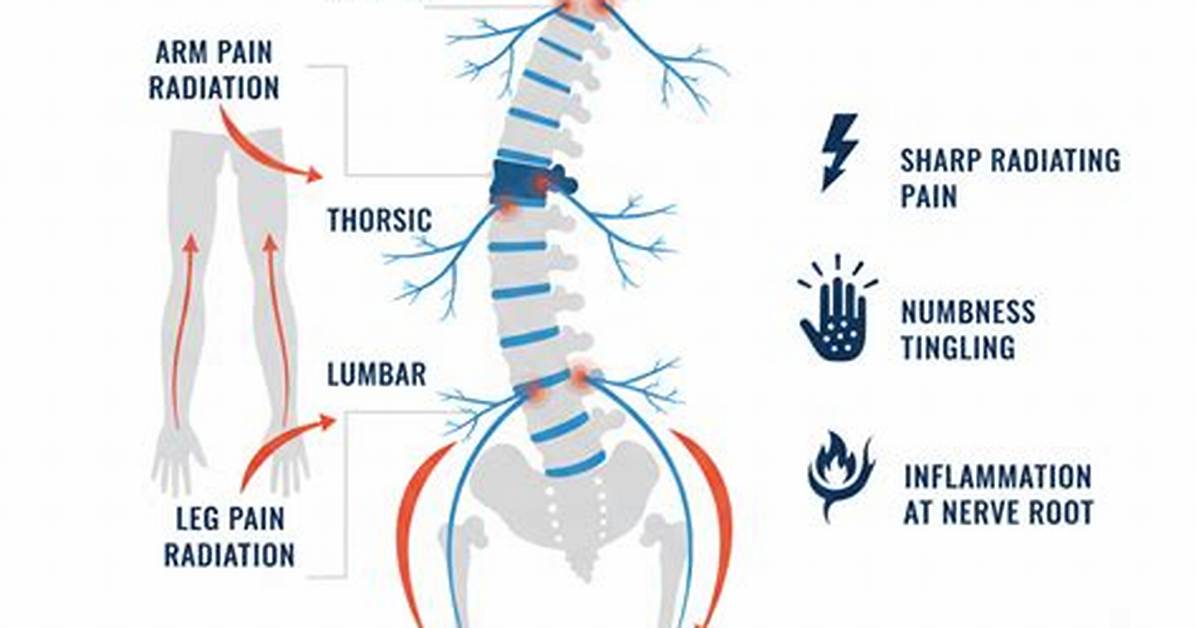 Radiculitis Definition