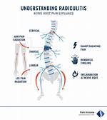 Radiculitis Definition