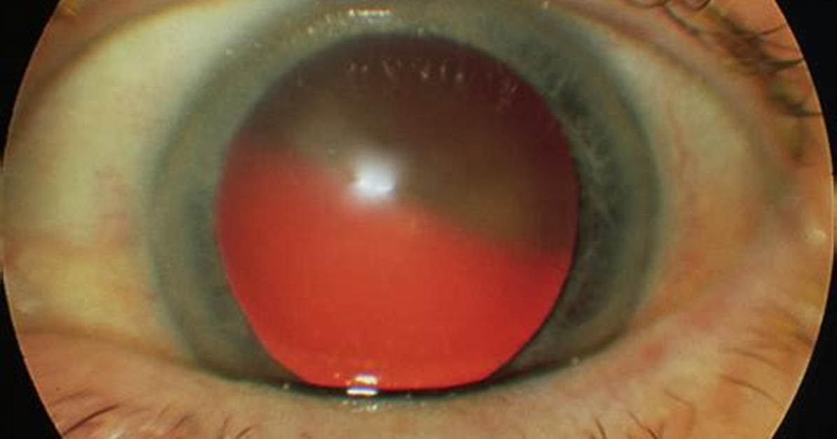 Red Reflex Eye