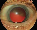 Red Reflex Eye