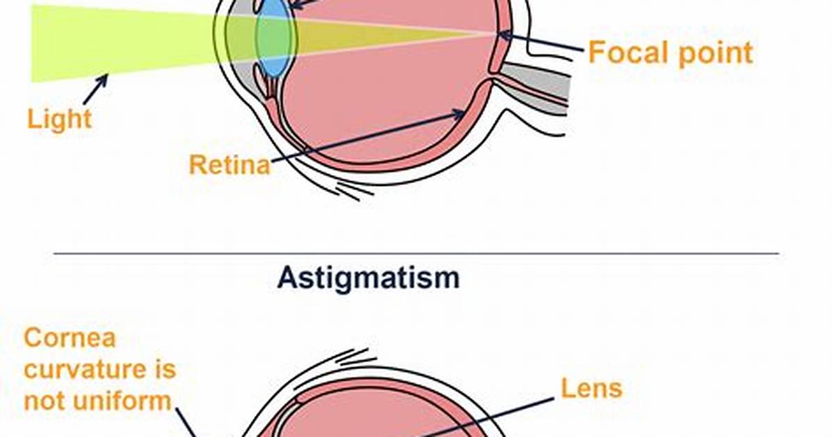 Regular Astigmatism