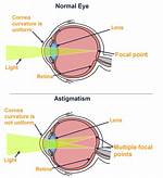 Regular Astigmatism