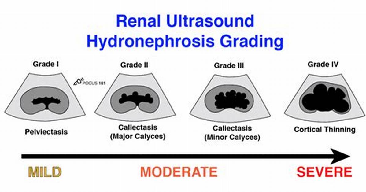 Renal Pelviectasis