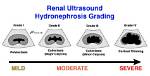 Renal Pelviectasis