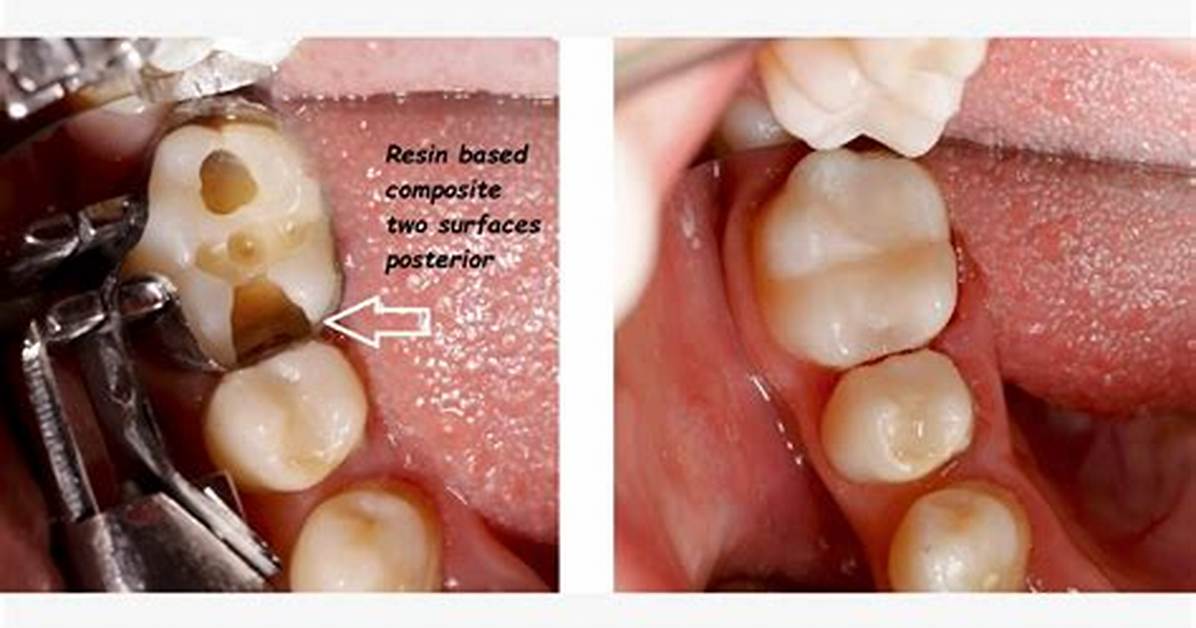 Resin Based Composite