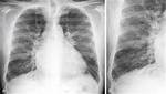 Reticular Opacities