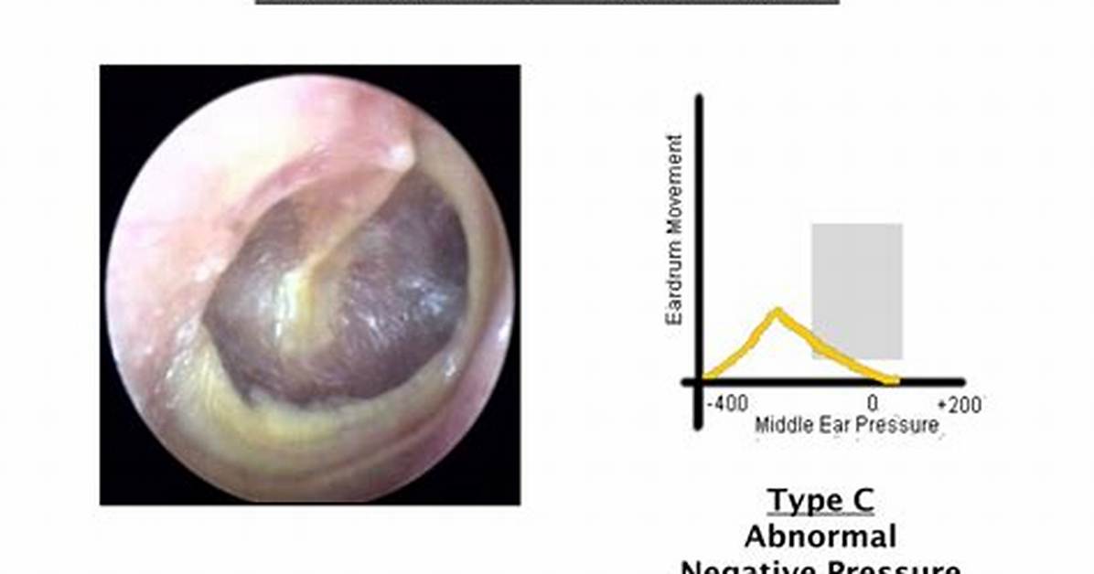 Retracted Eardrum