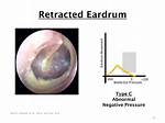Retracted Eardrum