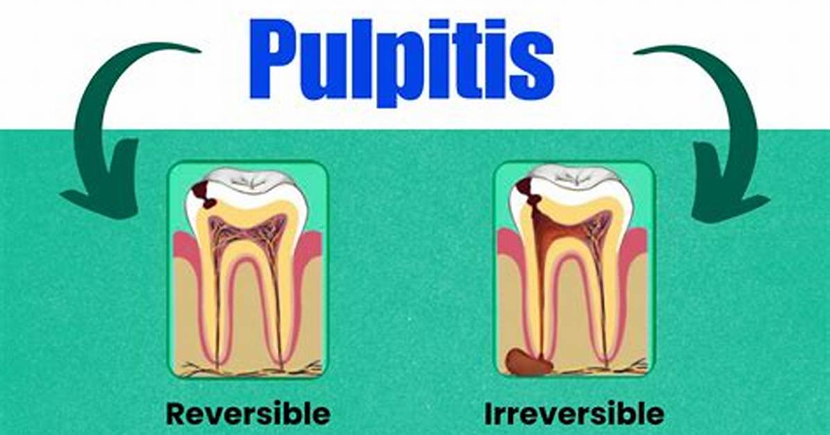 Reversible Pulpitis