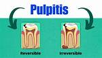 Reversible Pulpitis