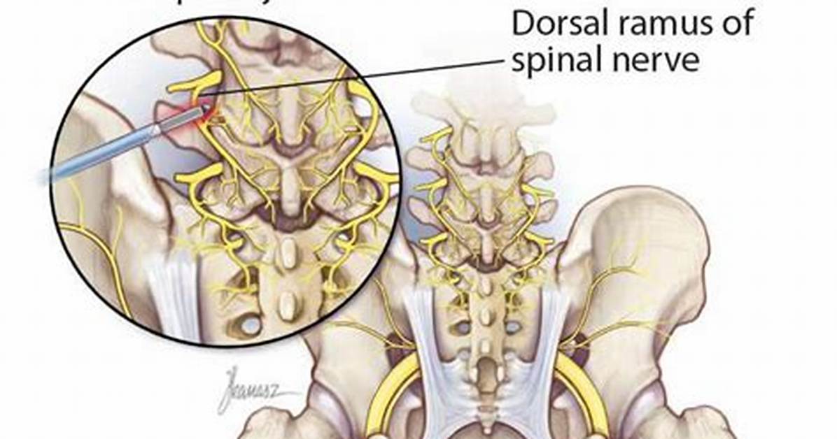 Rhizotomy Side Effects