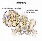 Rhizotomy Side Effects