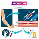 Routine Venipuncture