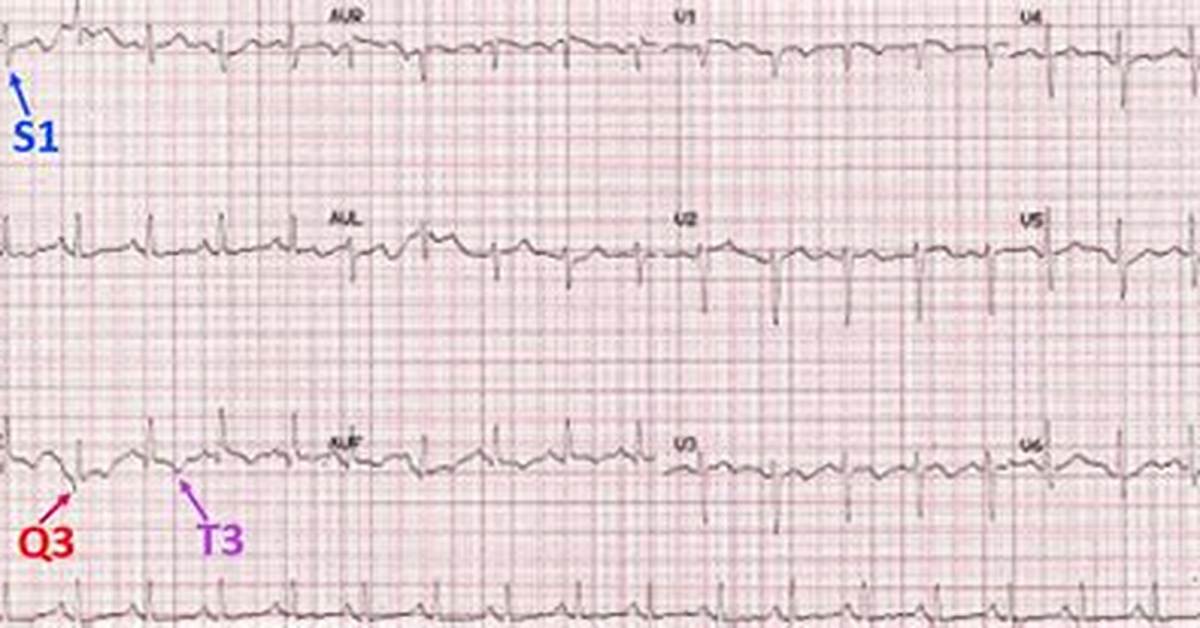 S1Q3T3 Pattern