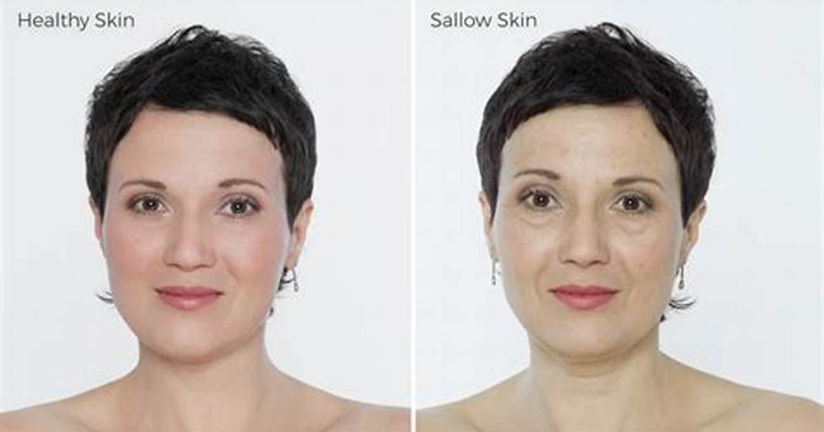 Sallow Complexion