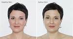 Sallow Complexion