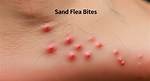 Sand Fleas Bites