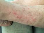 Sand Rash