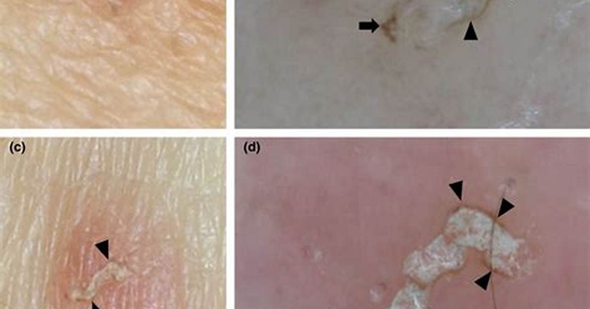 Scabies Gray Lines