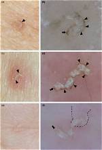 Scabies Gray Lines