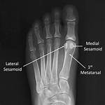 Sesamoid Bones Examples