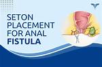 Seton Placement