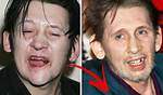 Shane Macgowan Teeth History