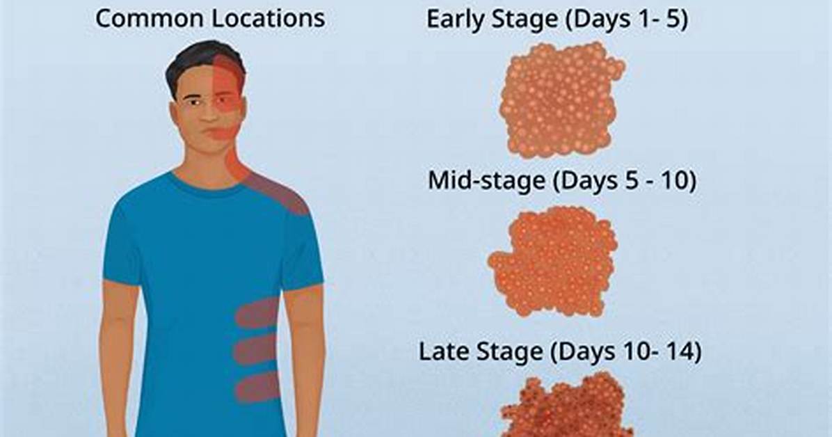 Shingles Stages